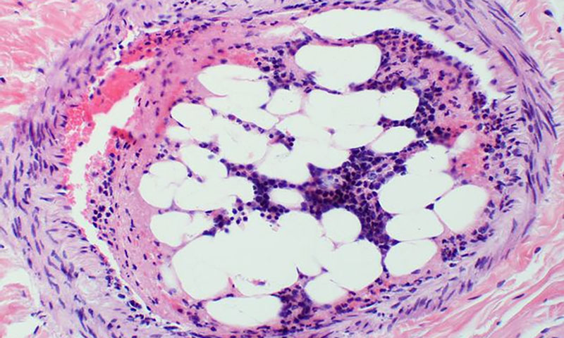 Bone Marrow Cells